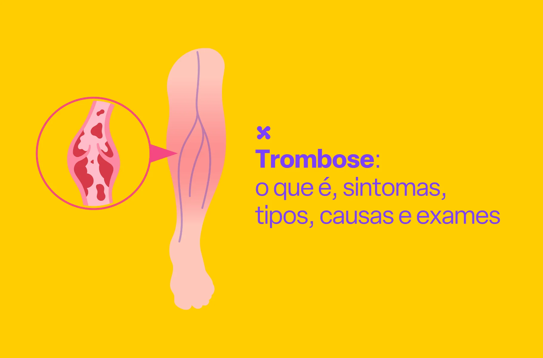 Trombose: o que é, sintomas, tipos, causas e exames