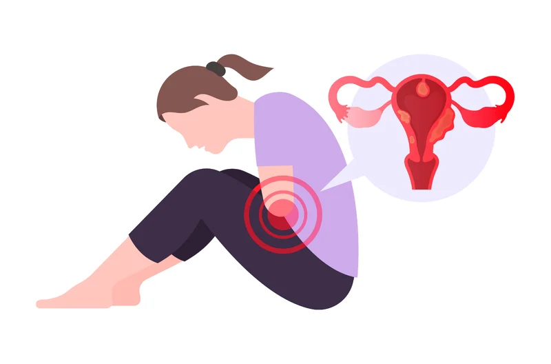 Endometriose: O que é, sintomas, como diagnosticar e como tratar