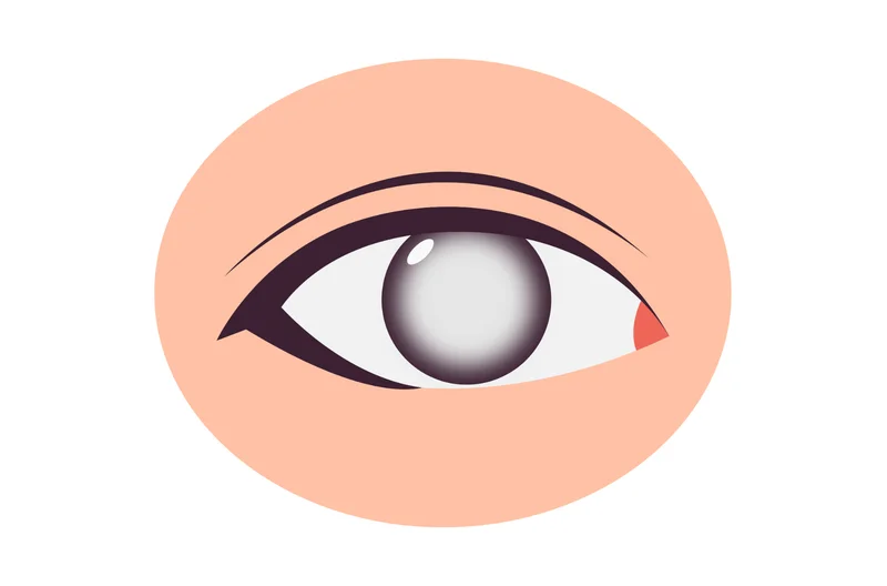 Retinoblastoma: O que é, como diagnosticar e tratar