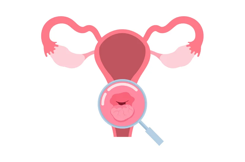 Câncer de colo de útero & HPV: como diagnosticar, como tratar e como prevenir