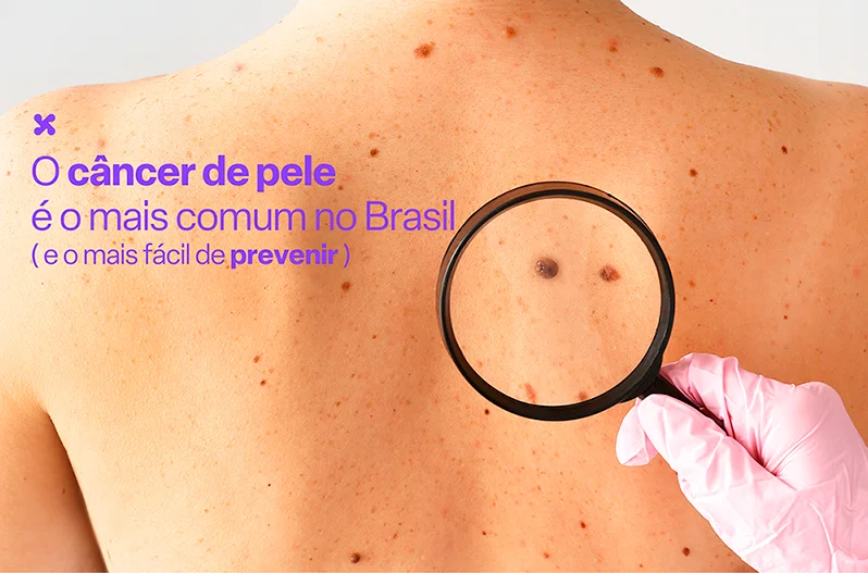 O câncer de pele é o mais comum no Brasil (e o mais fácil de prevenir)