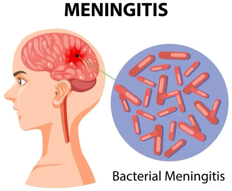 meningite
